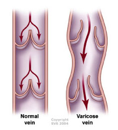 Exerciții pentru crotch varicose