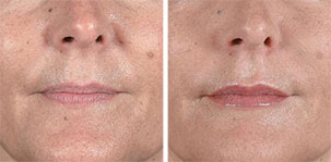 Treatment of Nasolabial Folds. Marbella Vein & Beauty CLinic in Spain.