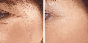 Correct of superficial lines, even in very sensitive skin areas. Marbella Vein & Beauty CLinic in Spain.