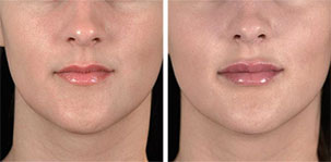 Natural Volume for Lips. Marbella Vein & Beauty CLinic in Spain.