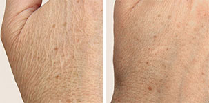 Skin Rejuvenation Dermal Filler for an refreshed, youthful look. Marbella Vein & Beauty CLinic in Spain.