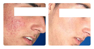 IPL acne treatment Before and After Photo. Marbella Vein & Beauty CLinic in Spain.