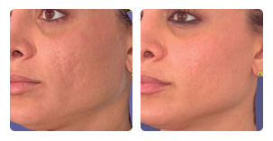 Laser skin resurfacing treatment Before and After Photo. Marbella Vein & Beauty CLinic in Spain.