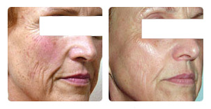 Laser skin photo resurfacing Before and After Photo. Marbella Vein & Beauty CLinic in Spain.