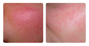 IPL vascular and pigmented lesion Before and After Photo. Marbella Vein & Beauty CLinic in Spain.