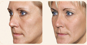 Filler Treatment Cheekbones Before and After Photo. Marbella Vein & Beauty CLinic in Spain.