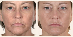 Filler Treatment Face contours, nasolabial folds and lip enhancement Before and After Photo. Marbella Vein & Beauty CLinic in Spain.